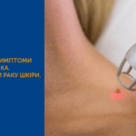 МЕЛАНОМА: СИМПТОМИ, ДІАГНОСТИКА ТА ПРОФІЛАКТИКА